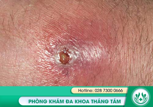 bệnh hậu môn