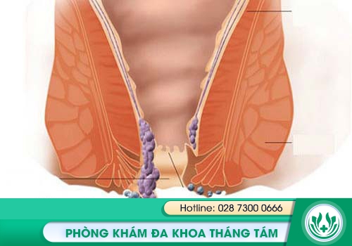 Có thể chữa bệnh trĩ bằng thuốc được không?