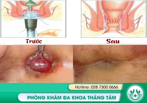 Hình ảnh trước và sau điều trị bệnh trĩ tại Phòng Khám Tháng Tám