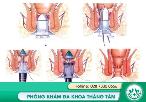 Phương pháp PPH - TST điều trị bệnh trĩ