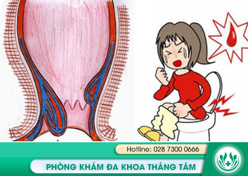 bị trĩ nội phải làm sao