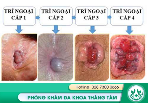 Hình ảnh về bệnh trĩ ngoại