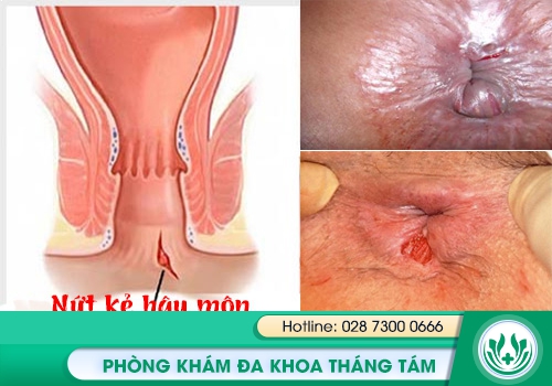 Hình ảnh về nứt kẽ hậu môn