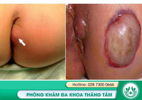 Hình ảnh vể áp-xe hậu môn