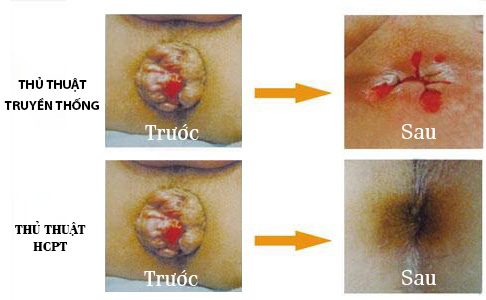 So sánh kết quả Trước và sau khi thủ thuật của 2 phương pháp