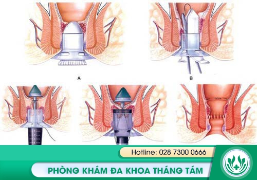 Phương pháp PPH chữa bệnh trĩ hiệu quả, không tái phát