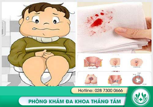 Đi cầu ra máu có thể do bệnh trĩ gây ra