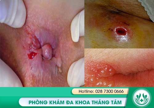 Sưng hậu môn, đau hậu môn, ngứa xung quanh vùng hậu môn là bị bệnh gì?