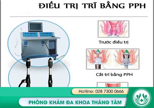 Chữa trị chảy máu hậu môn do bệnh trĩ bằng phương pháp PPH