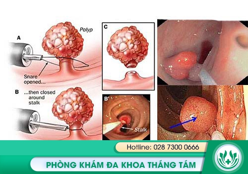 Polyp hậu môn trực tràng cũng gây đi vệ sinh ra máu