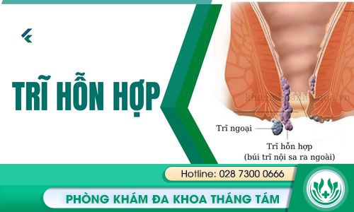 trĩ hỗn hợp