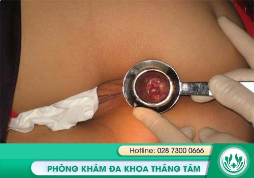 Bệnh trĩ nội khó nhận biết vì có diễn biến âm thầm